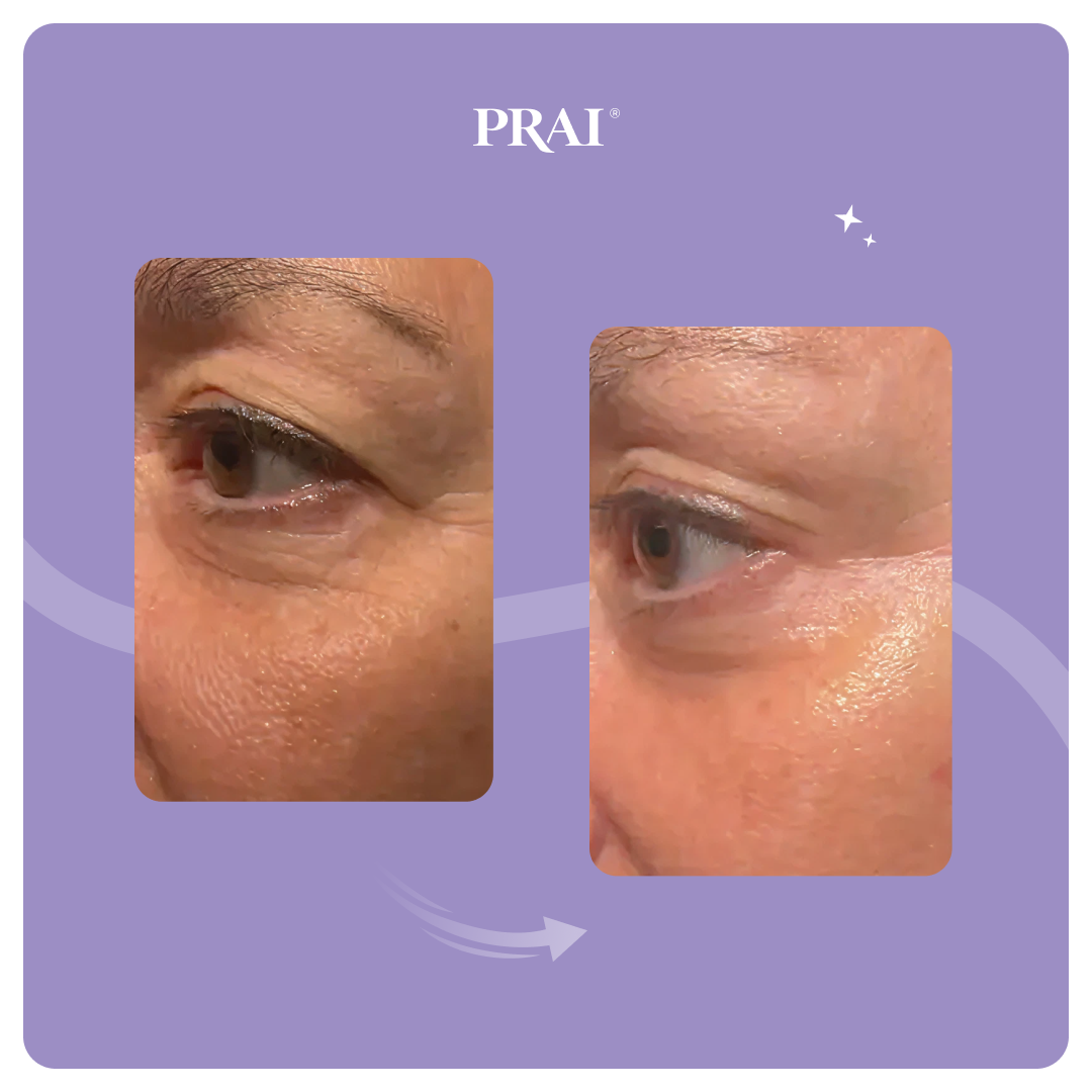Eye tight uplift serum close-up, eye and brow area in two panels