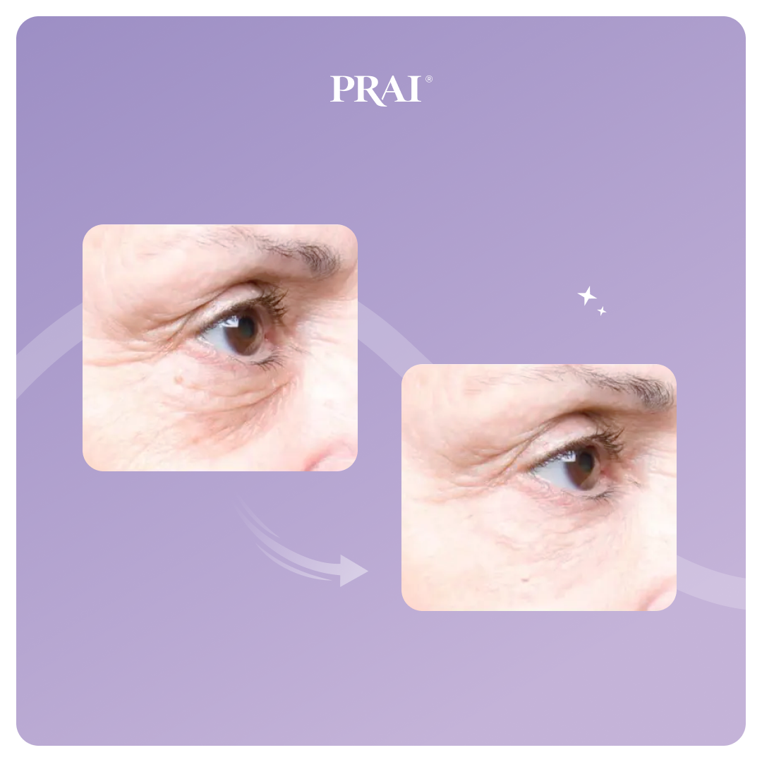 Eye tight uplift serum before-and-after close-up, eye and brow area
