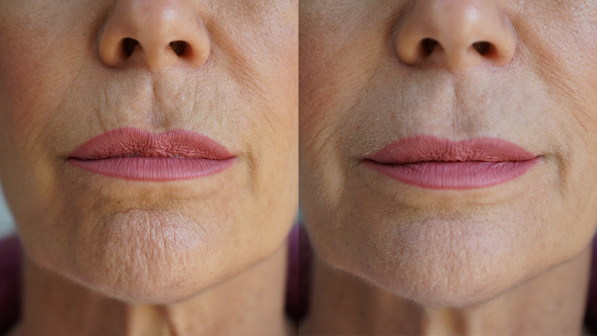 Lip filler results: smoother lips with fewer visible lines, before-and-after close-up