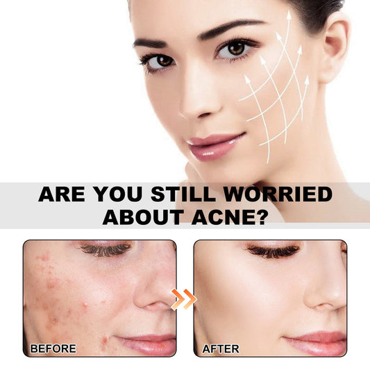 Facial skincare with acne treated area, hydrocolloid patch look for clearer skin