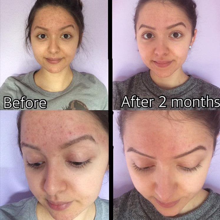 Before-and-after acne skin photos, same person with improved complexion after 2 months