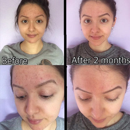 Before-and-after acne skin photos, same person with improved complexion after 2 months