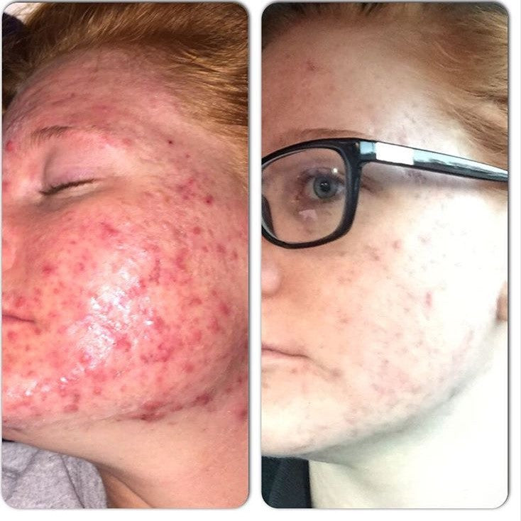 Close-up of facial skin with red acne breakouts and irritation on cheeks