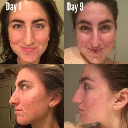 Side-by-side acne skin progress photos, Day 1 vs Day 9 on face