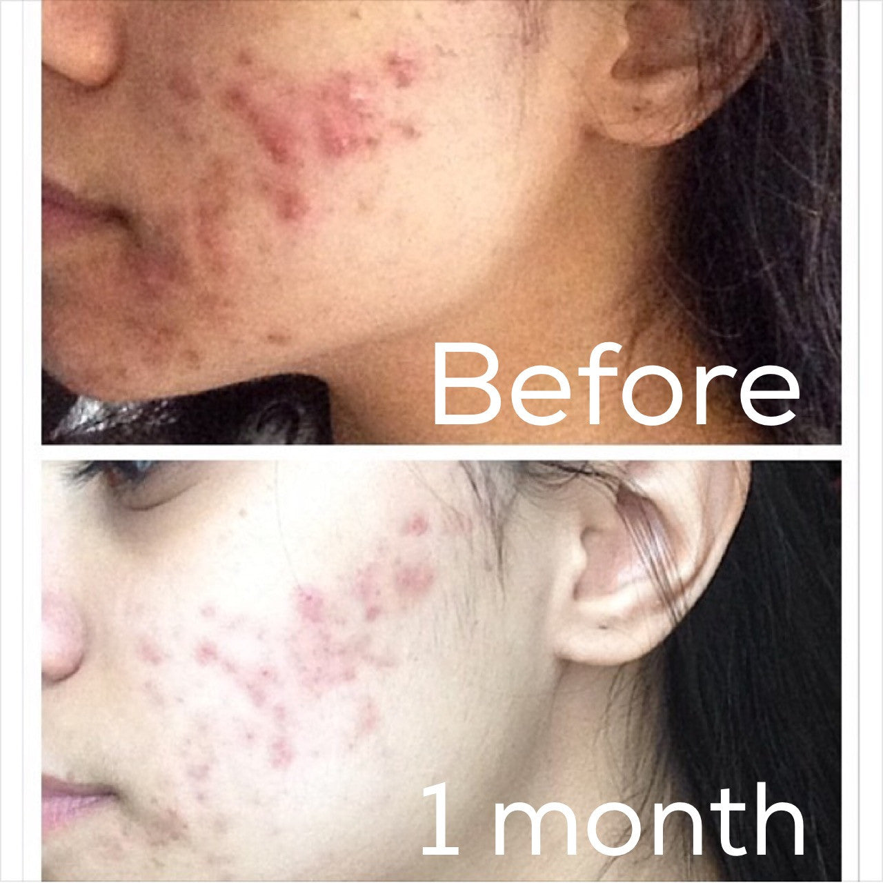 Jawline acne photos showing before and after 1 month