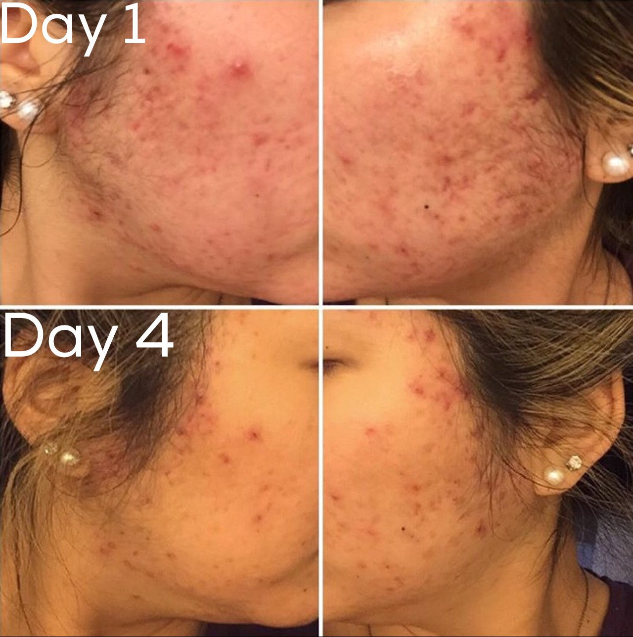 Acne skin progress photos of neck and cheek, Day 1 vs Day 4