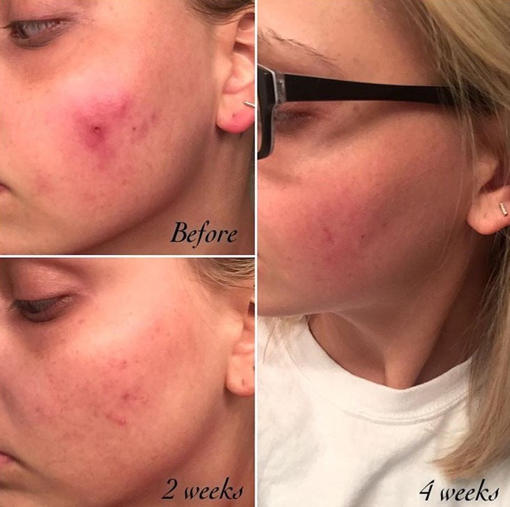 Close-up acne skin before and after 2 weeks, then 4 weeks comparison