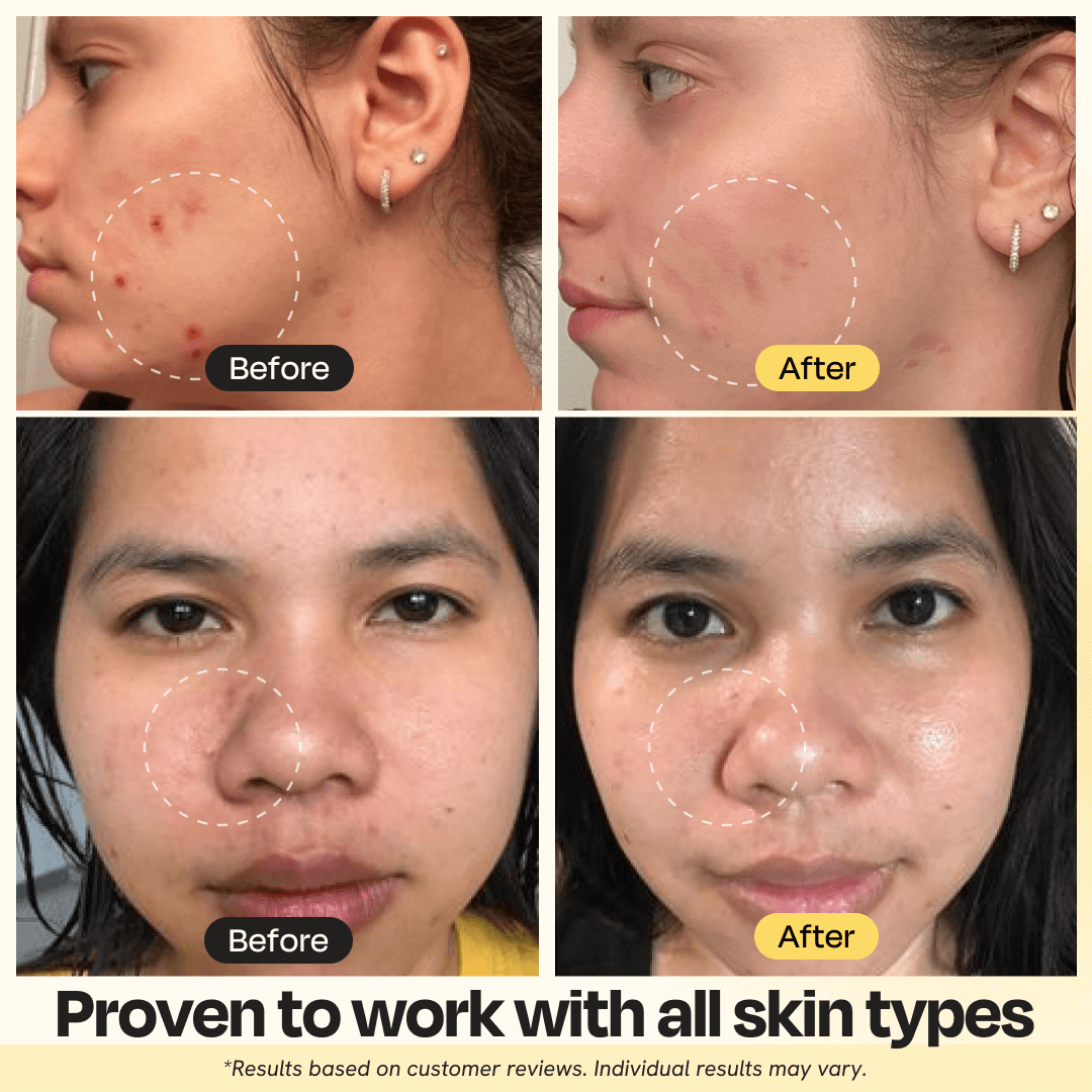 Vitamin C clay mask applied to face with marked spots, before-and-after view